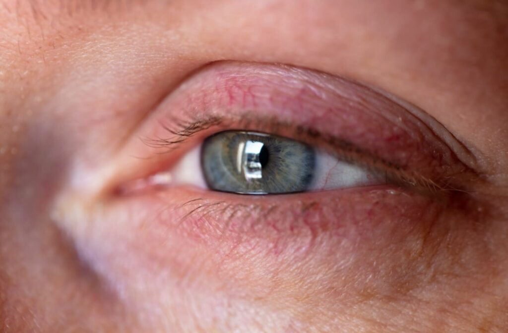 A close-up of eye showing dry eye symptoms