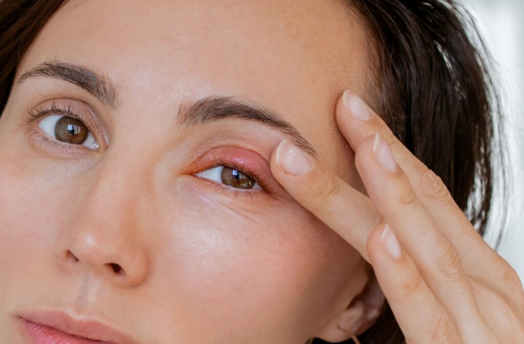 A close-up of a person showing redness on their upper eyelid.